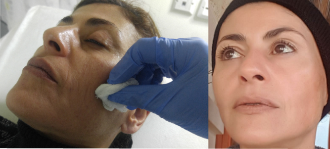 כתמי עור וגיל